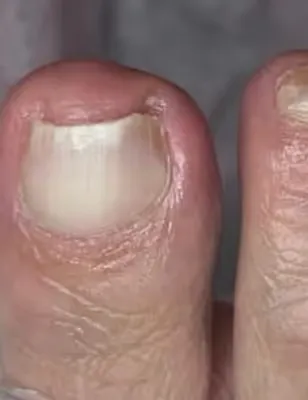 Orivelle nail appearance example