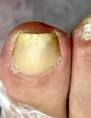 Orivelle nail care progress image