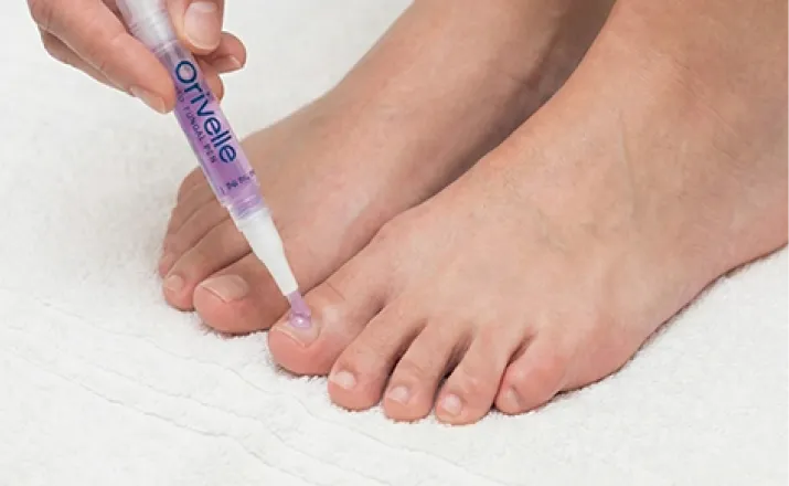 Preparing a nail before applying Orivelle